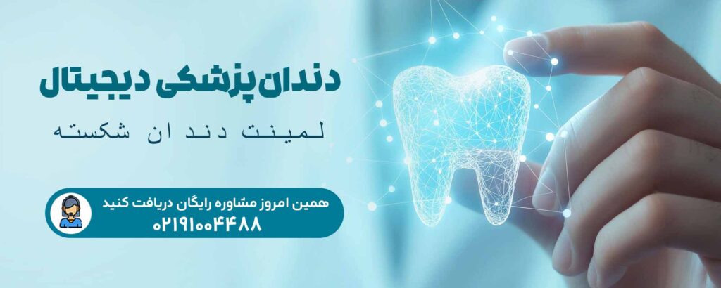 لمینت دندان شکسته