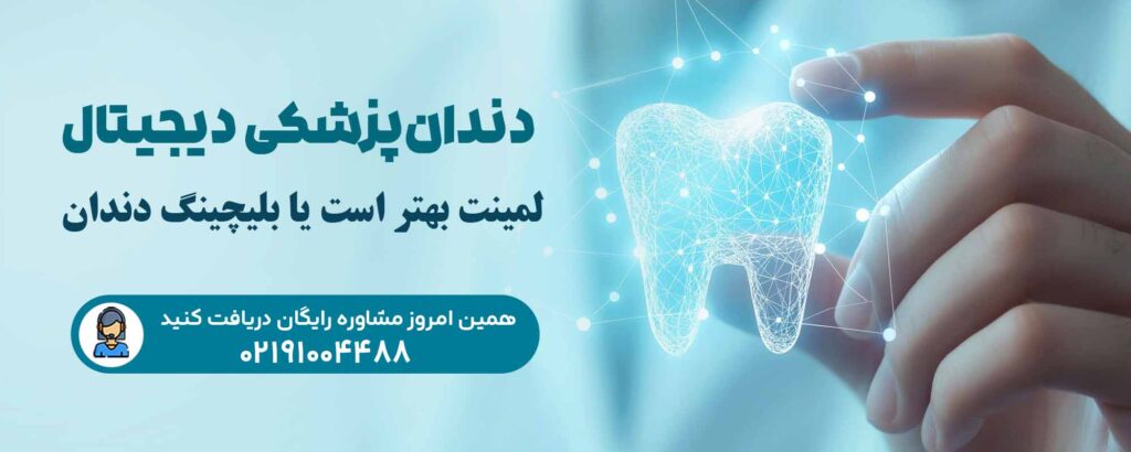 لمینت یا بلیچینگ