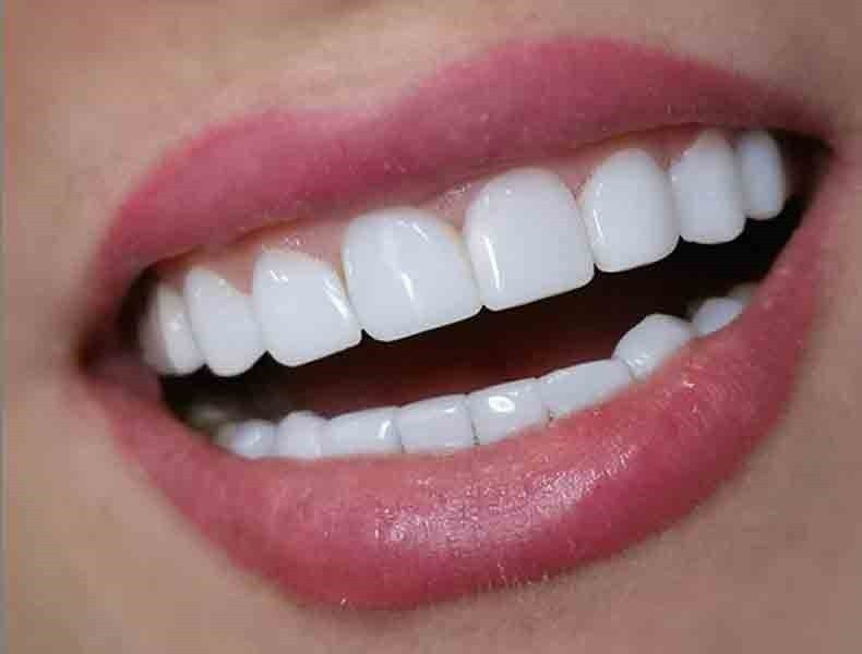 لمینت یا بلیچینگ