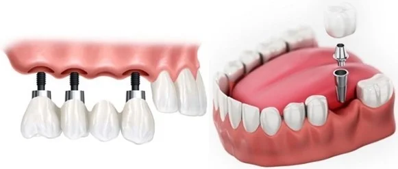 ایمپلنت دیجیتال چگونه انجام میشود؟