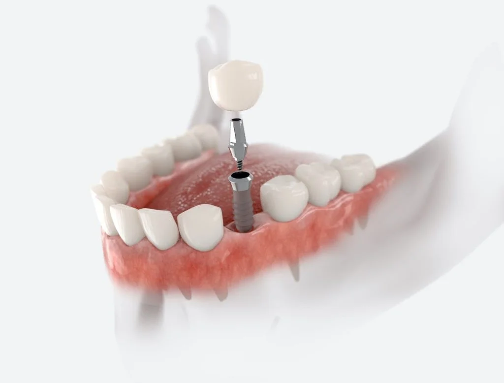 ایمپلنت دیجیتال چگونه انجام میشود؟