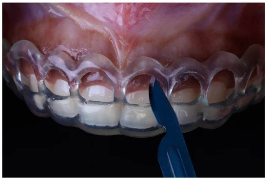اهمیت استفاده از گاید جراحی لیفت لثه