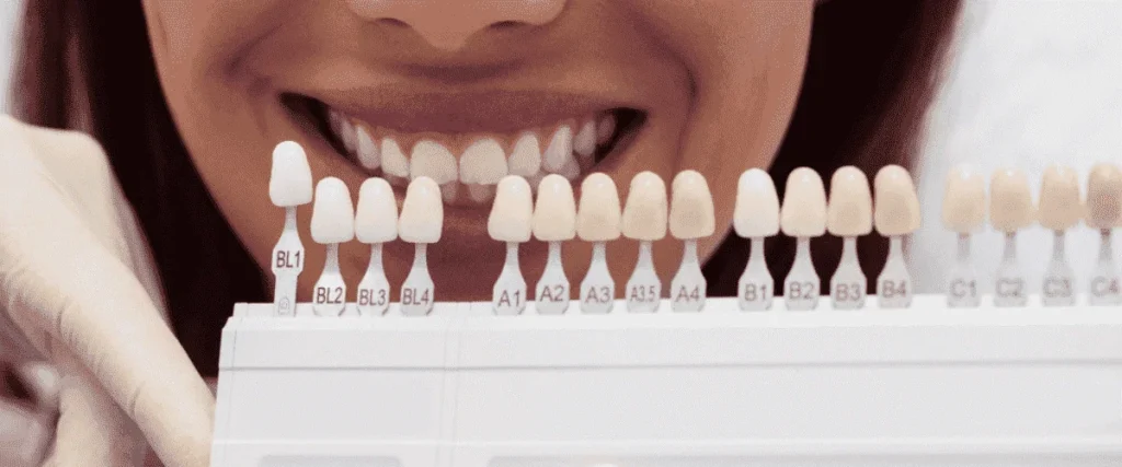 بهترین کلینیک دندانپزشکی برای اجرای ونیرهای کامپوزیت