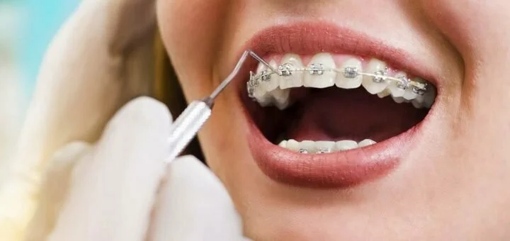 بهترین روش برای رفع ناهنجاری دندان