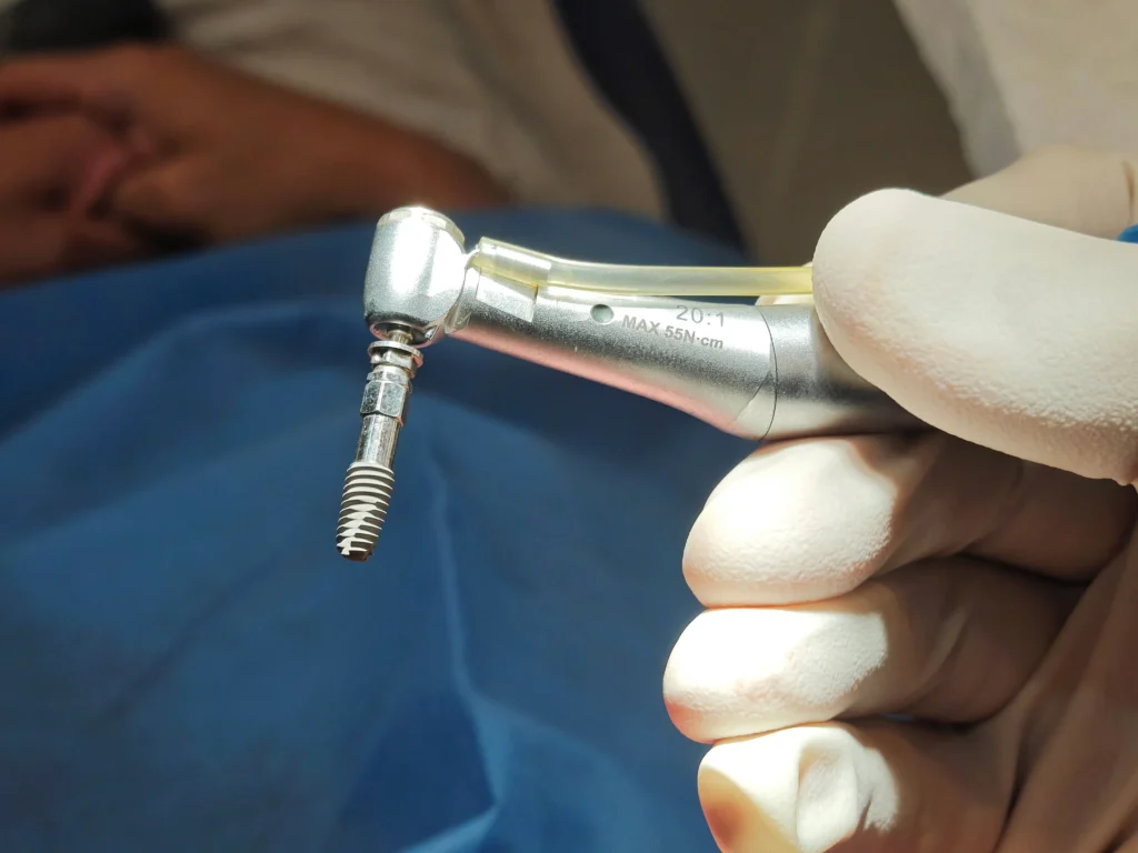 درمان ریشه دندان ;Root Canal Therapy 
