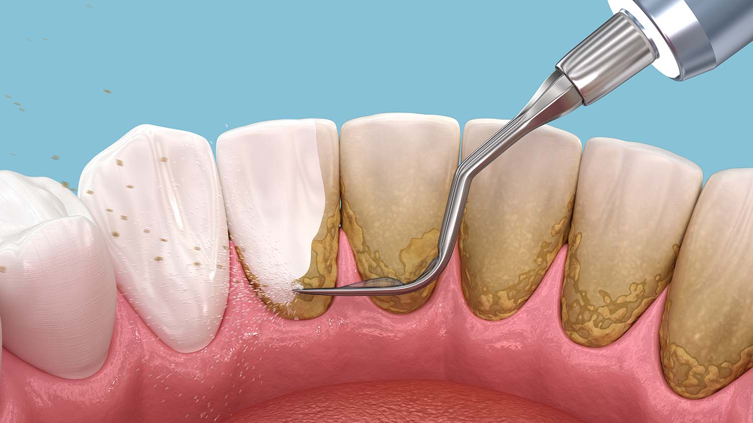 چگونه از جرم و پلاک دندان جلوگیری کنیم؟