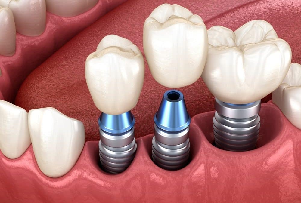 Dental implants