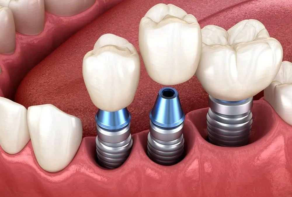 Immediate implants
