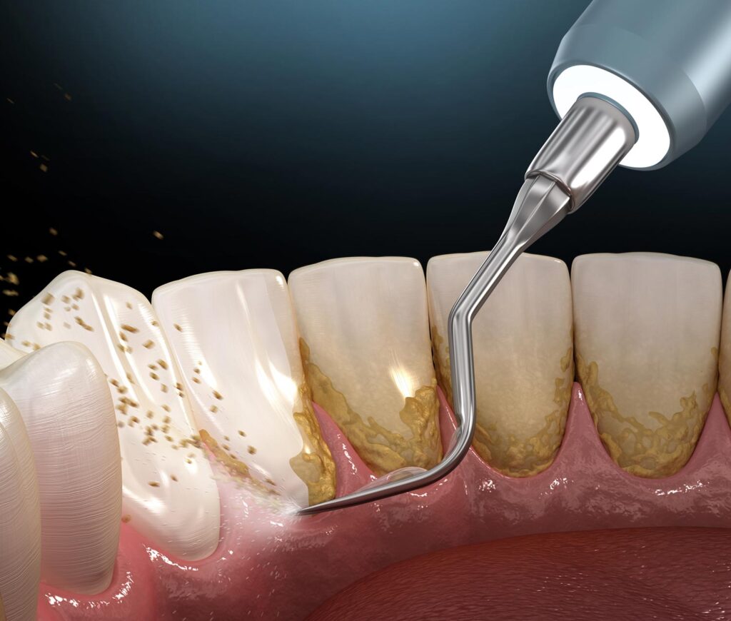 چگونه از جرم و پلاک دندان جلوگیری کنیم؟