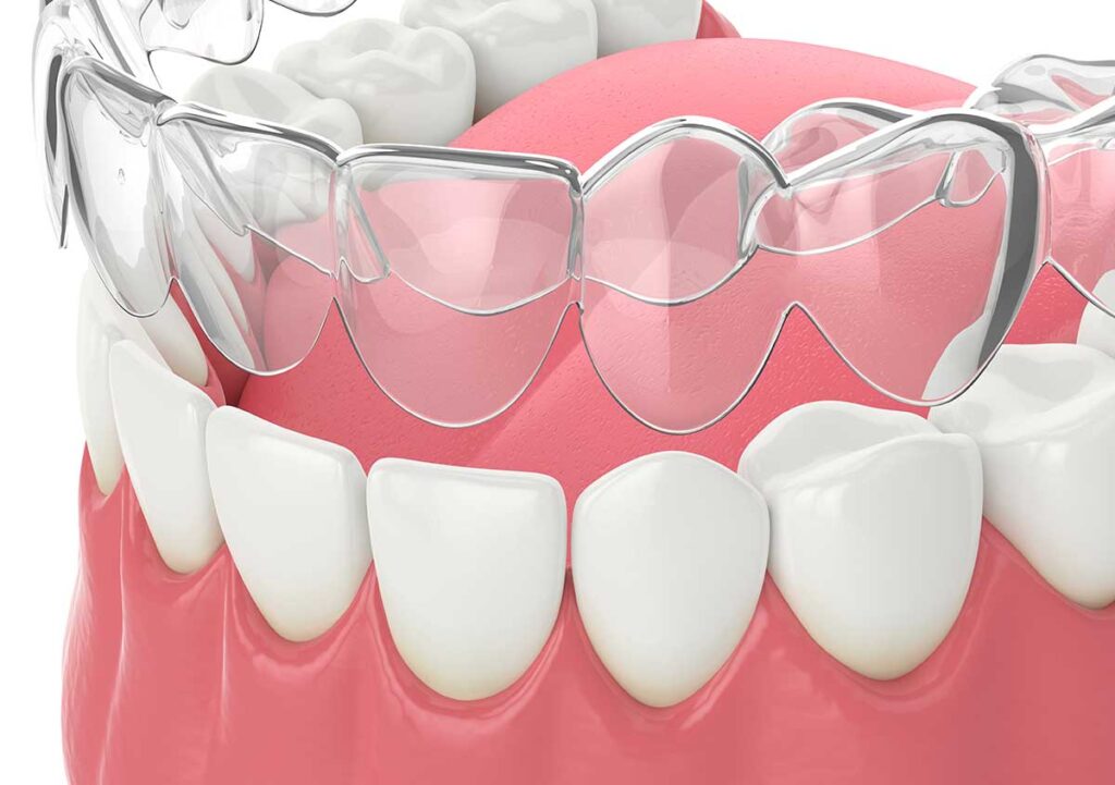 Clear orthodontics