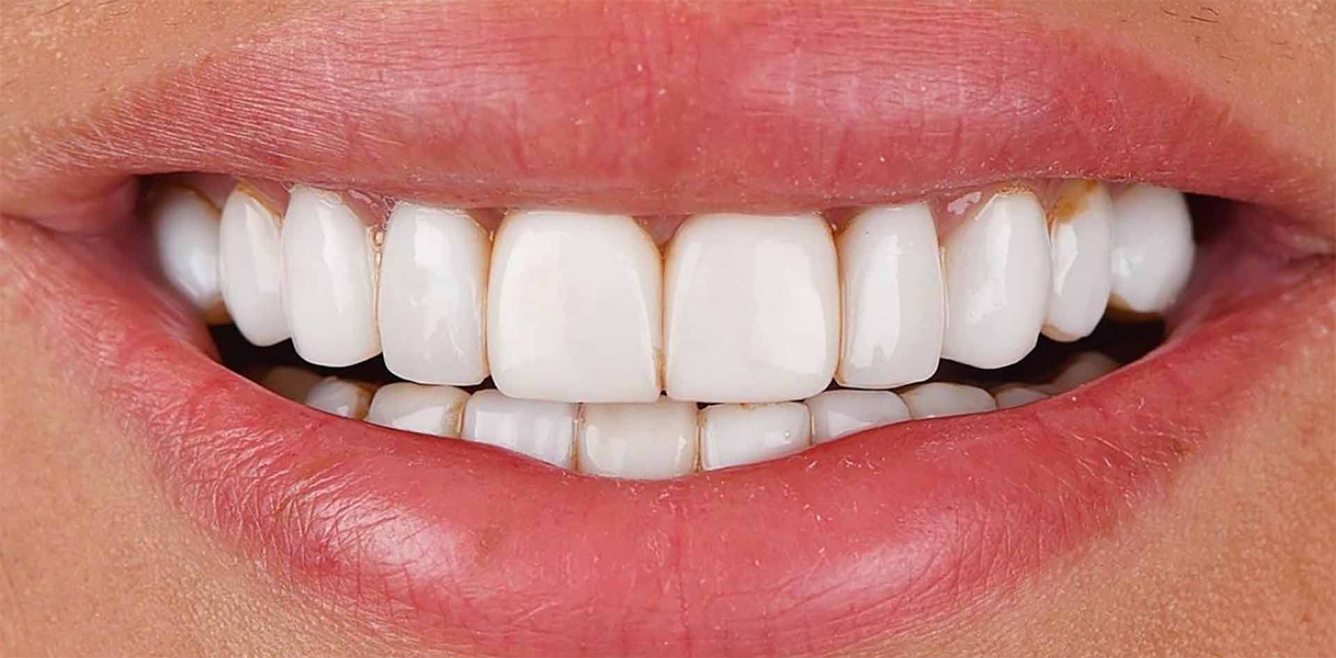 The cost of dental composite