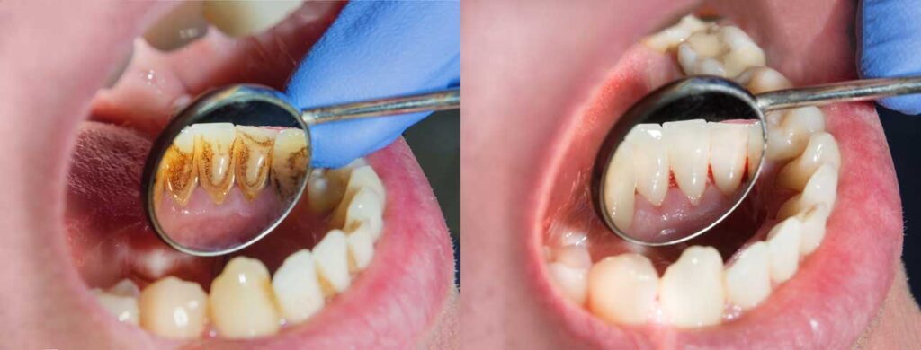 Dental scaling
