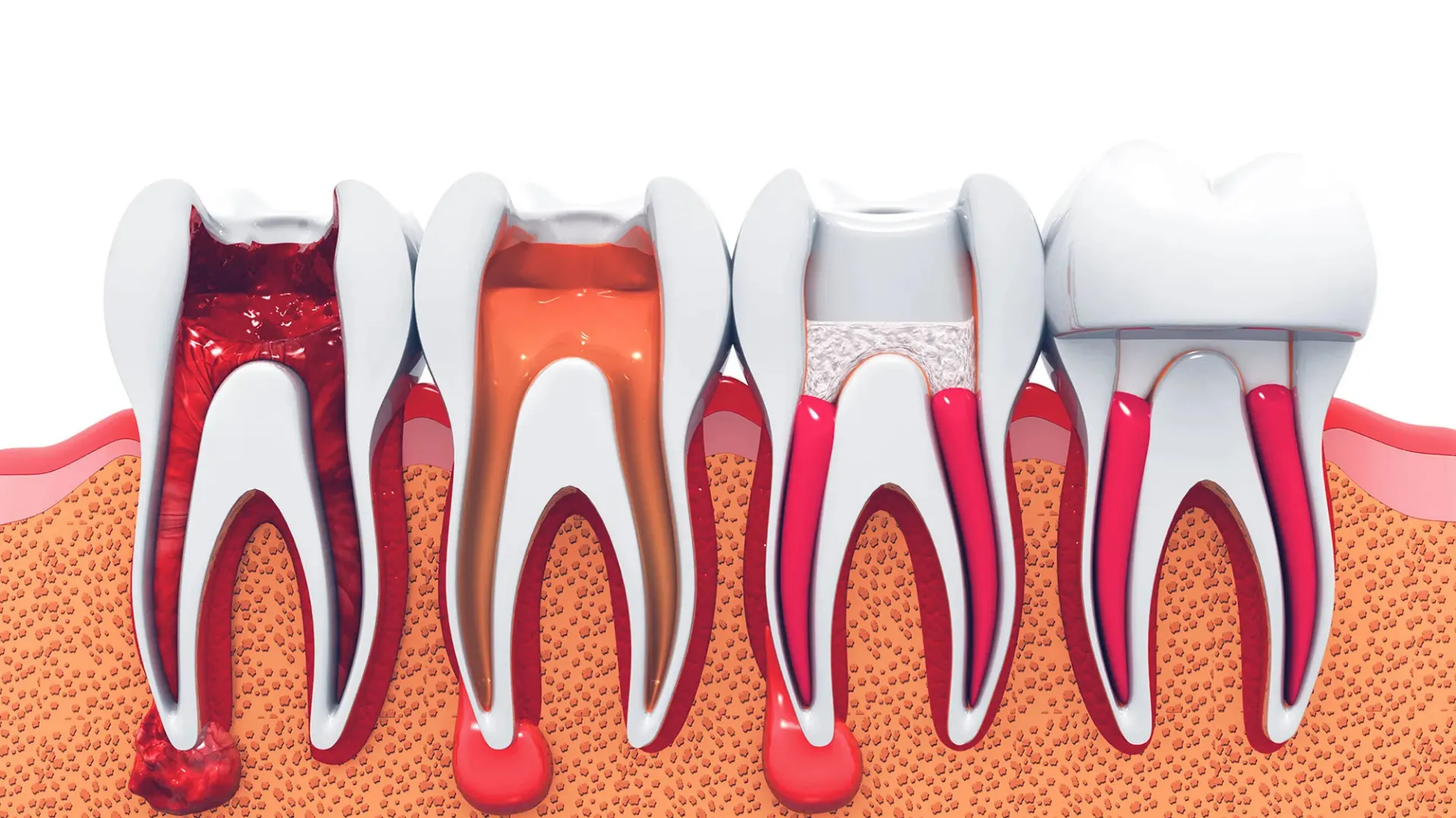 درمان ریشه دندان ;Root Canal Therapy