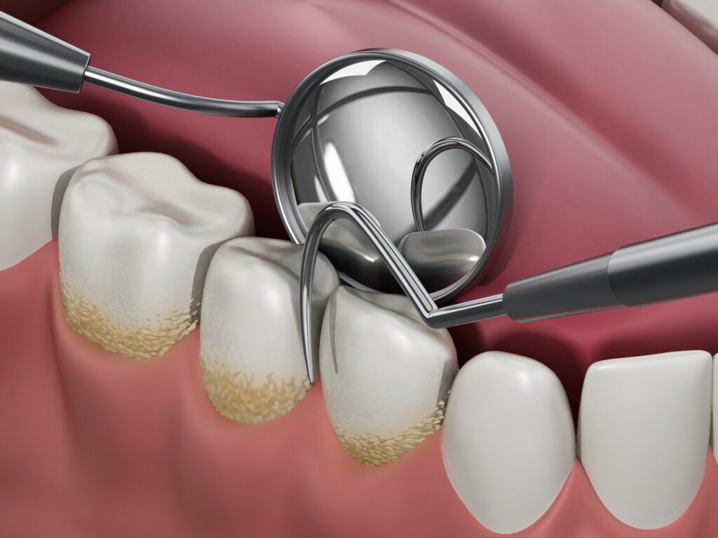 چگونه از جرم و پلاک دندان جلوگیری کنیم؟