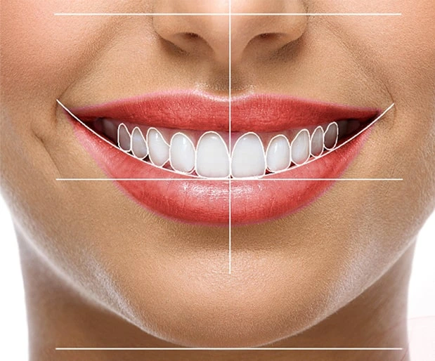 اصلاح طرح لبخند در کلینیک آریل دنتال