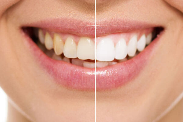 Dental scaling