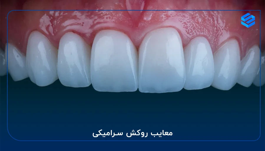 روکش دندان