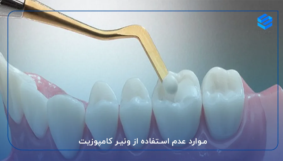 Dental composite veneer
