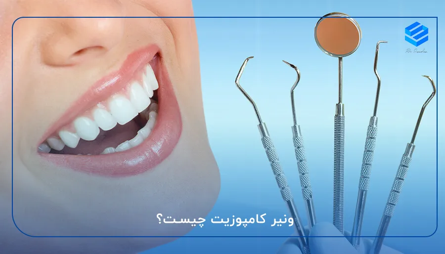 Dental composite veneer