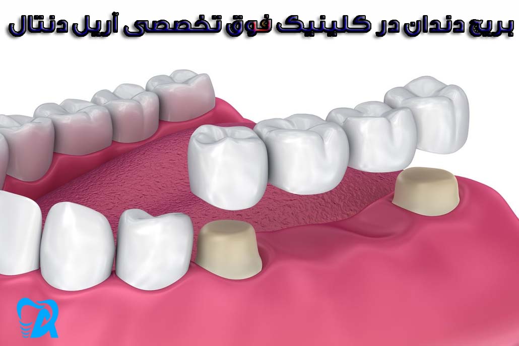 بریچ دندان در کلینیک آریل دنتال