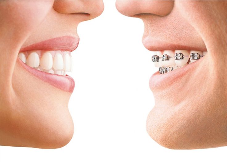 تاثیر ارتودنسی دندان بر چهره