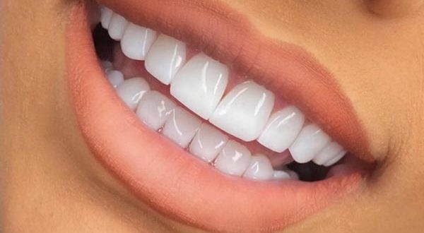 سن مناسب برای کامپوزیت دندان
