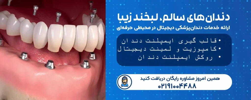 روکش ایمپلنت دندان