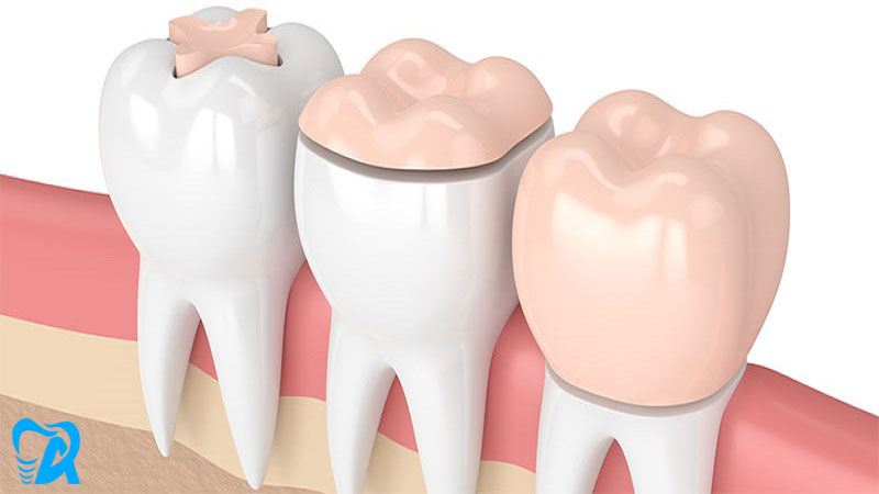 تاج گذاشتن دندان چیست و چه نکاتی درباره آن باید بدانیم؟