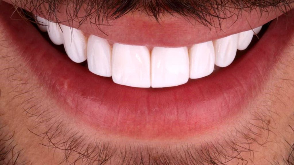 سن مناسب برای کامپوزیت دندان