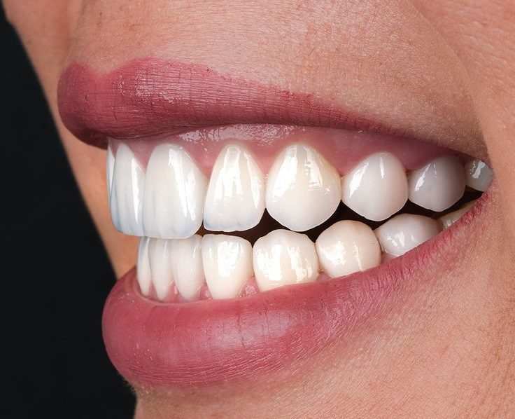 مقایسه تفاوت لمینت ایمکس و زیرکونیا با جزئیات