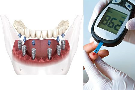 ایمپلنت دندان برای افراد دیابتی