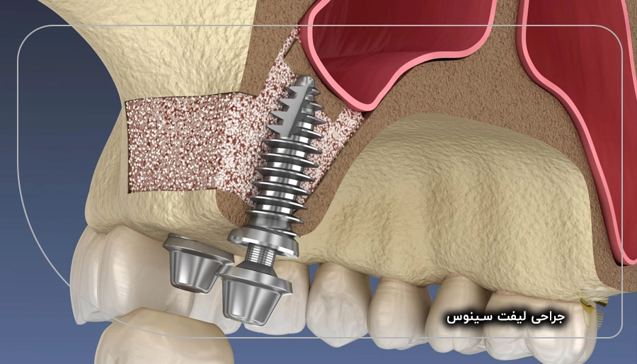 جراحی لیفت سینوس