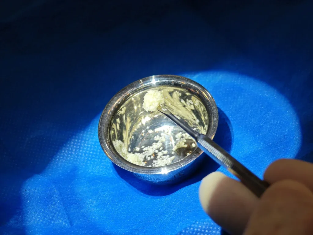 آماده سازی پودر استخوان برای (Bone Grafting)