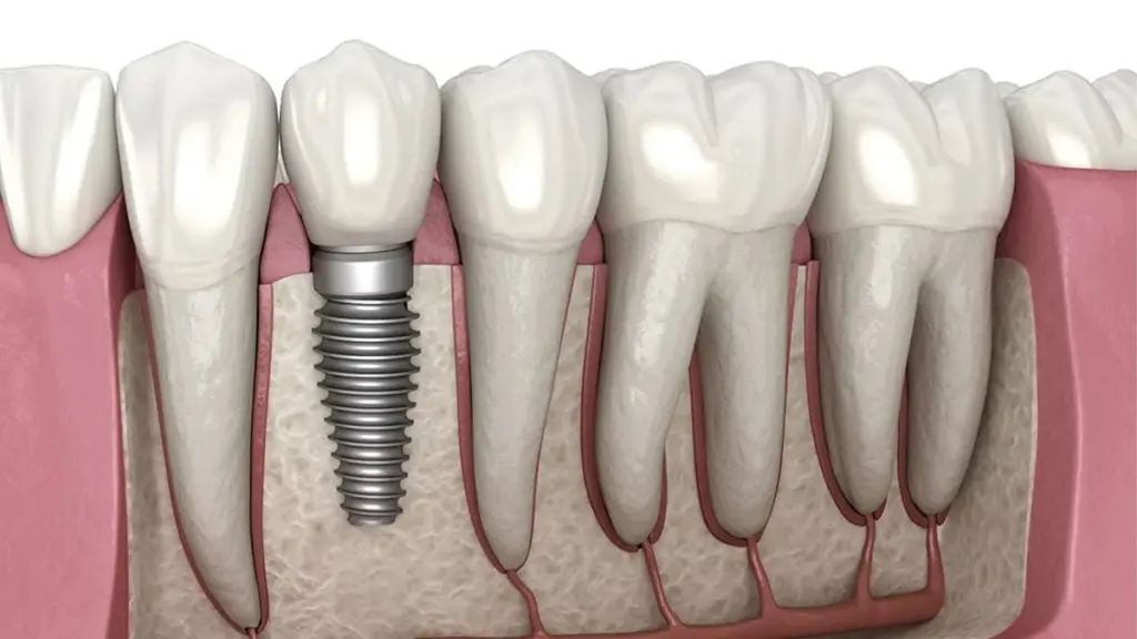 استفاده از خدمات ایمپلنت اقساطی در تهران