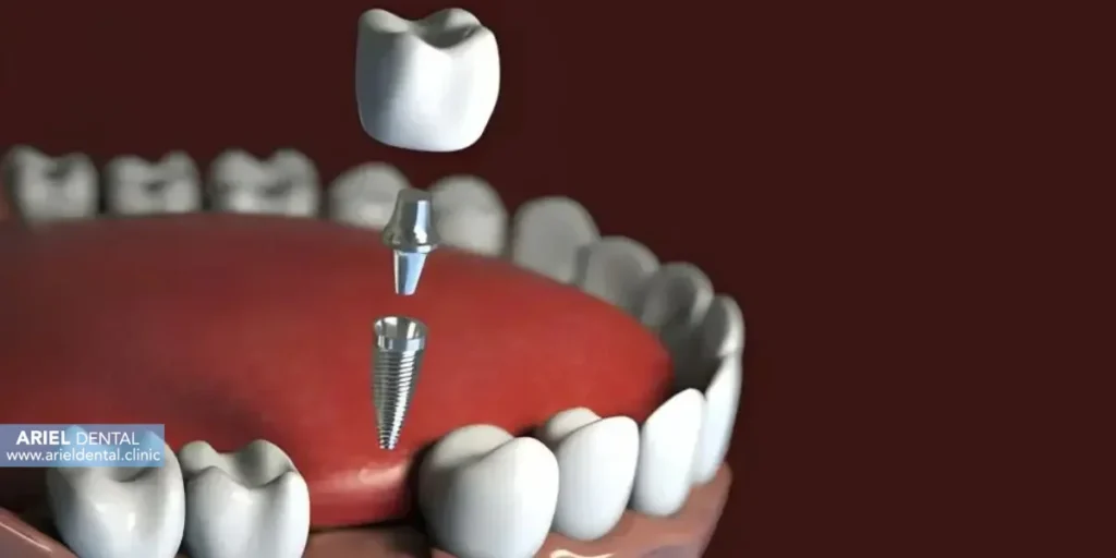خدمات تخصصی ایمپلنت در آریل