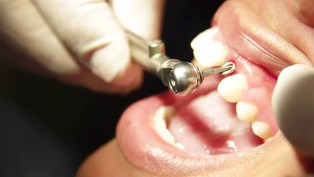 چه مدت بعد از کشیدن دندان باید ایمپلنت کرد؟