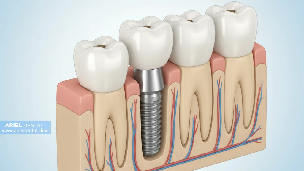 انتخاب برند مناسب ایمپلنت