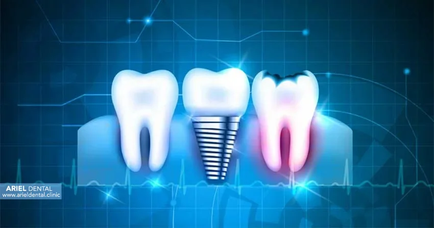 هزینه ایمپلنت دیجیتال در نیاوران