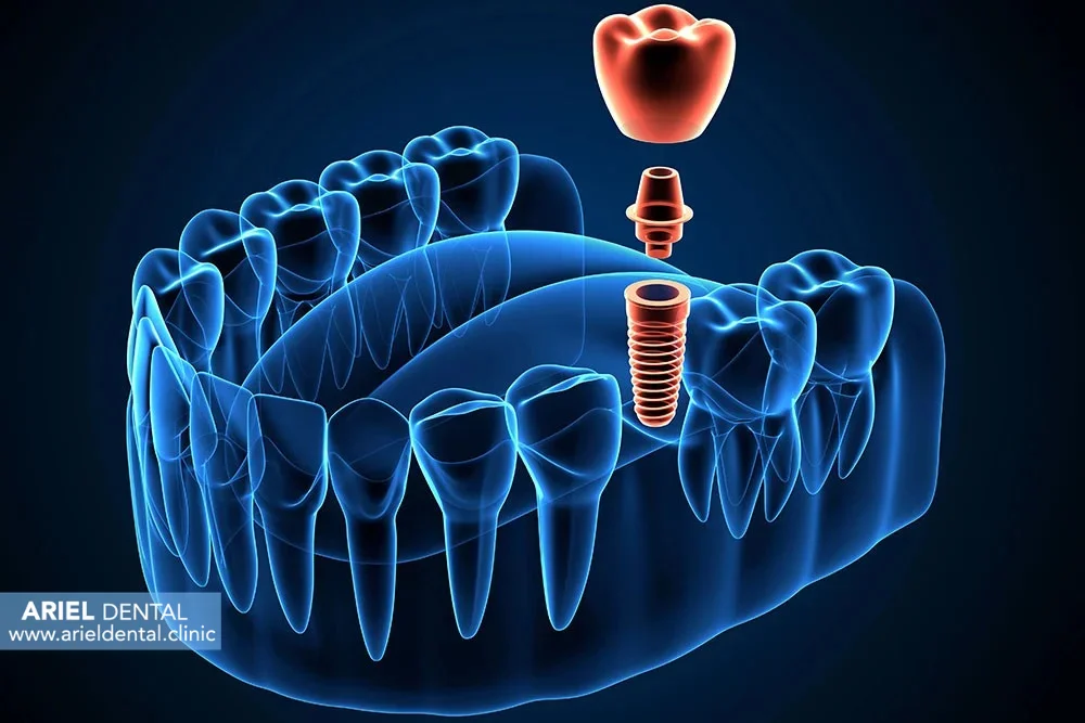 ایمپلنت دیجیتال در نیاوران