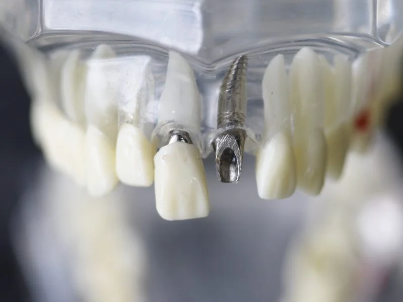 مزایای کاشت ایمپلنت در زمان مناسب