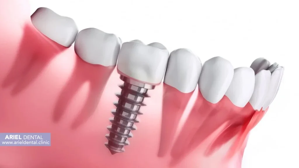 مقایسه ایمپلنت ایتالیایی با محصولات  آلمانی و برزیلی