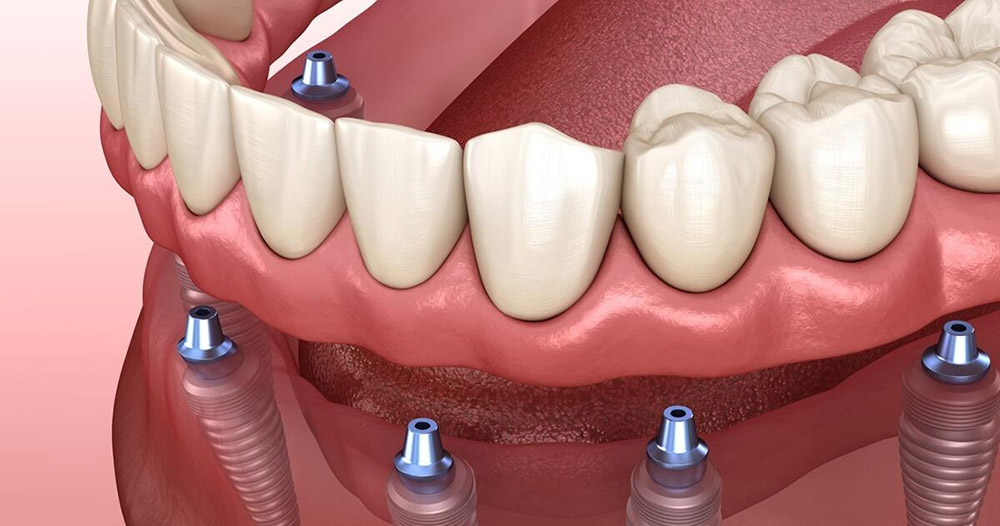 ایمپلنت متحرک دندان
