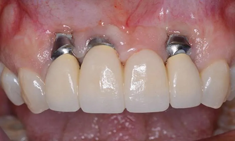 عفونت ایمپلنت دندان