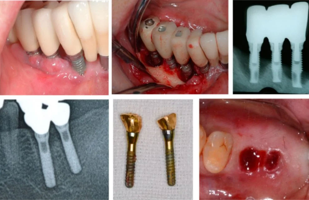 مصرف آنتی بیوتیک برای درمان عفونت ایمپلنت دندان