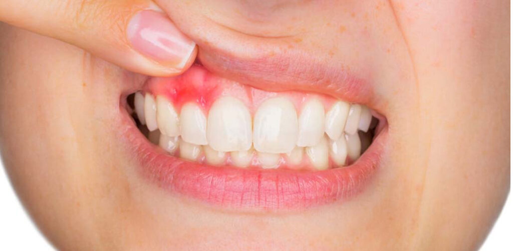 بهترین برندهای ایمپلنت دندان برای جلوگیری از عفونت