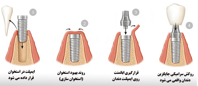 مراحل ایمپلنت دندان