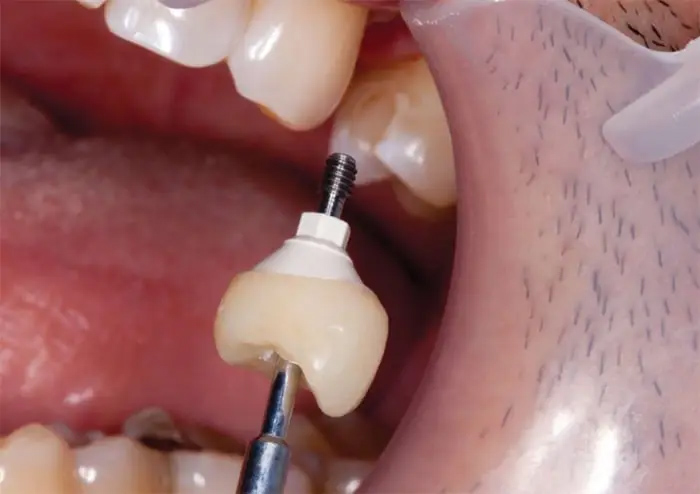 روکش دندان ایمپلنت