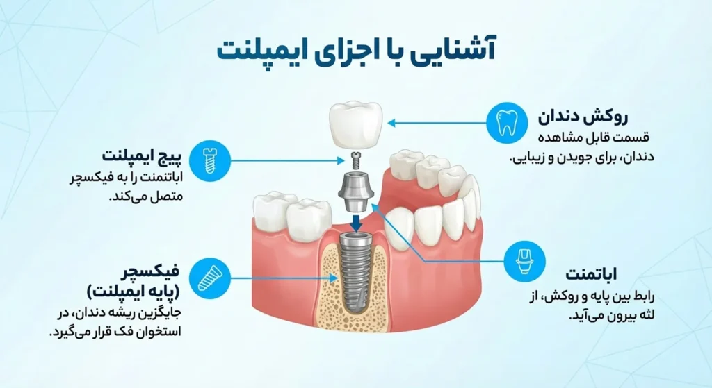 آشنایی با اجزا ایمپلنت