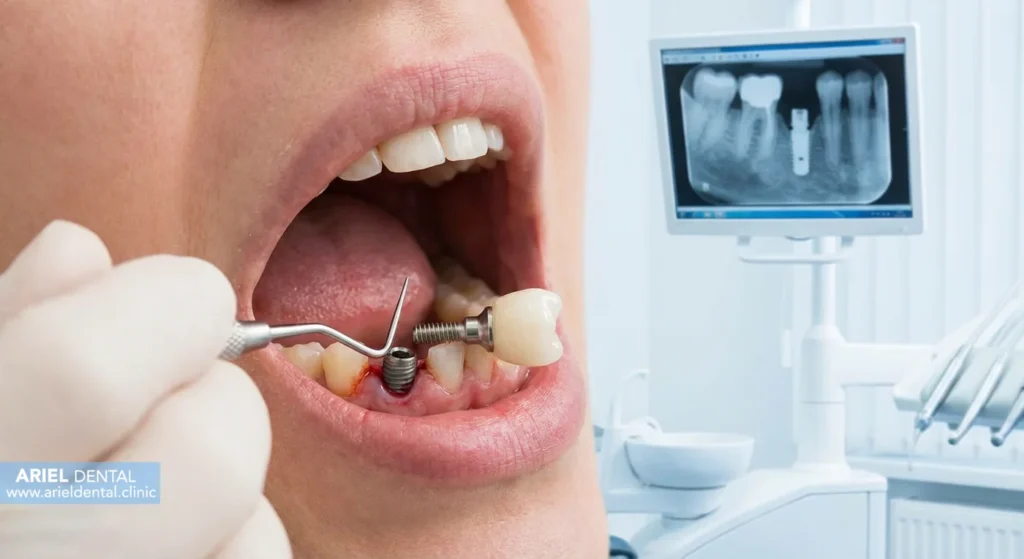 درمان لق شدن ایمپلنت