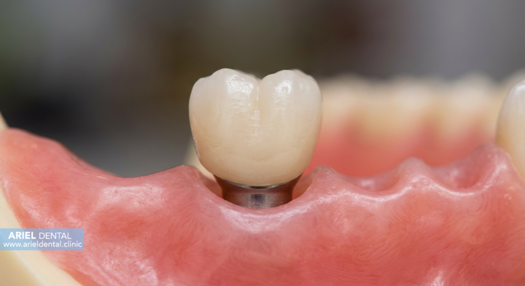 ایمپلنت دندان